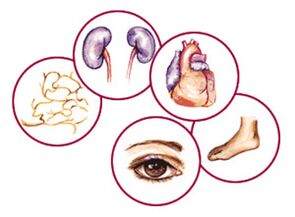 Organ with complications of diabetes mellitus